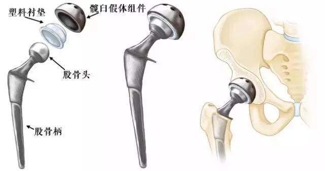 股骨头置换会有哪些后遗症？