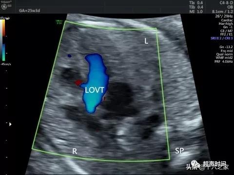 你的育儿经|胎儿下腔静脉缺如