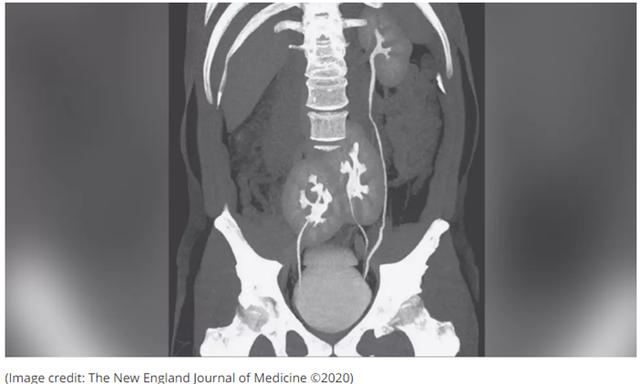 2020年十大怪异医学事件：有人体内长了三颗肾，还有人对冷空气过敏