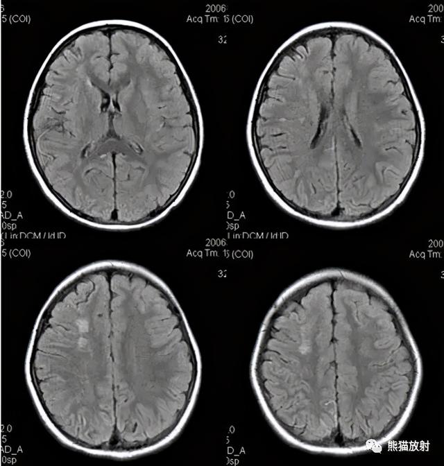 烟雾病的CT及MRI诊断