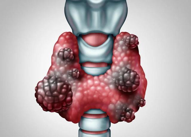 每5人就有1人有甲状腺结节！出现2种症状，说明癌症找上门