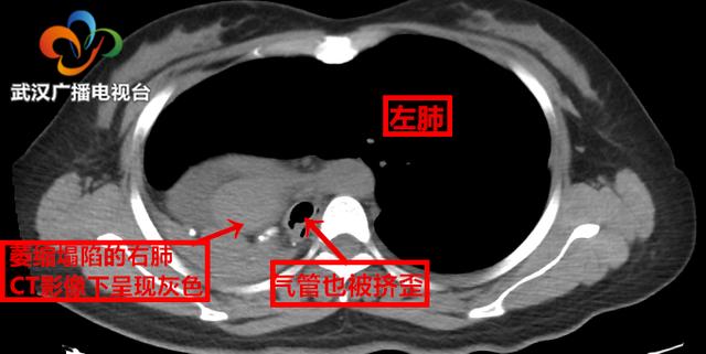 右肺泄气“病退”左肺和心脏“鸠占鹊巢”医生奇招化解脏腑“抢地盘”