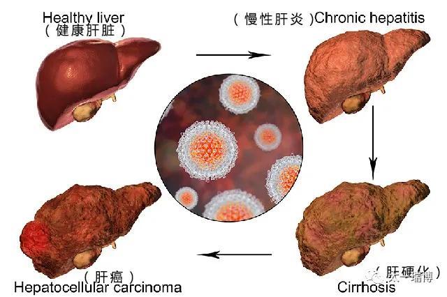 乙肝病毒百万携带者，2个月转阴，中医治疗乙肝再获突破