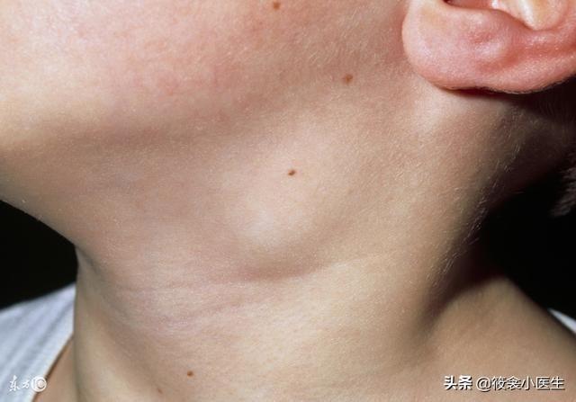 超级宝妈|跟“儿童怪病”很像的川崎病，你认识么？