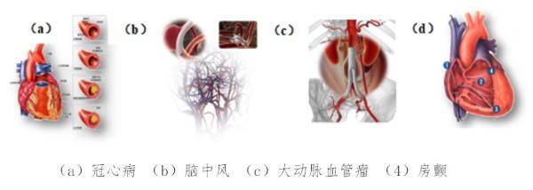 纤维管|微创介入医疗器械贵在哪？它占材料成本七成，在心脑血管打通自己的路