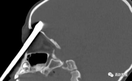 颅内|螺丝刀穿眼眶入颅，幼儿命悬一线，注意这些危险物品→