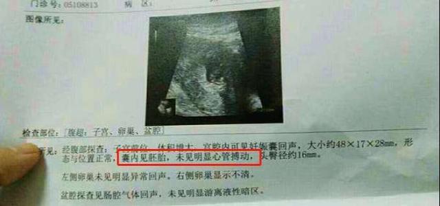 你的育儿经▲怀孕10周看不到胎心，是胎儿发育不好吗？孕早期做好4点远离胎停