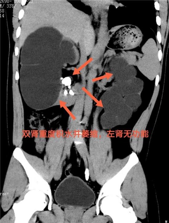 湖南30岁小伙身体不痛不痒，小结石却让他丢了一个肾