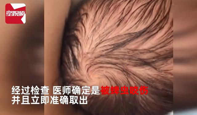 发现|惊险！出生仅4天婴儿被蜱虫咬伤，父亲：发现时头全部吸进去了