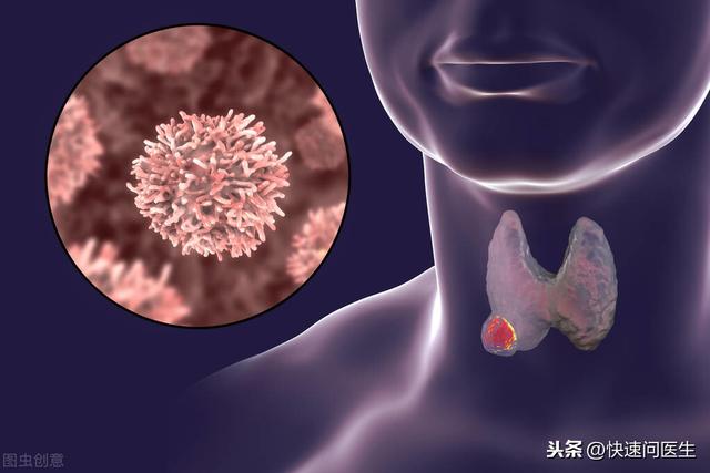 甲状腺癌最“善良”？其实也分“好坏”，揭开甲癌的秘密