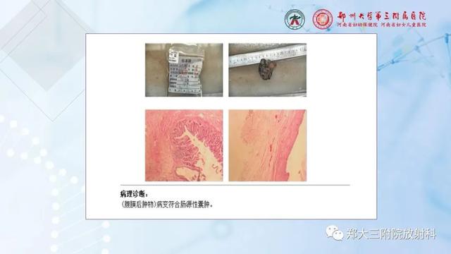 儿童腹部囊性病变诊断思路分析