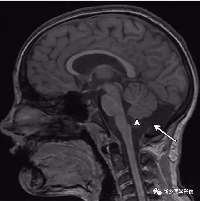 大脑中线处常见的25种疾病