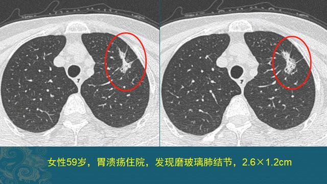 肺癌能治好吗？医生解释3个阶段的治疗数据，避免人财两空