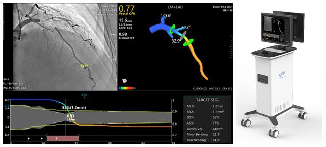 冠脉|我国冠心病患者达1100万，新一代AI-QFR冠脉精准诊断系统全球首发