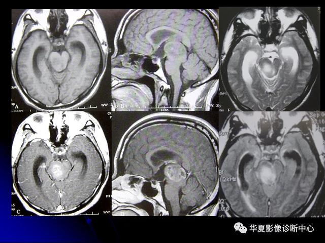 「影像复习」脑干区常见病变影像表现