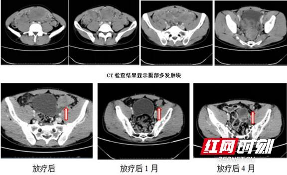 湘雅常德医院实施全腹腔放疗治疗促纤维增生性小圆细胞肿瘤