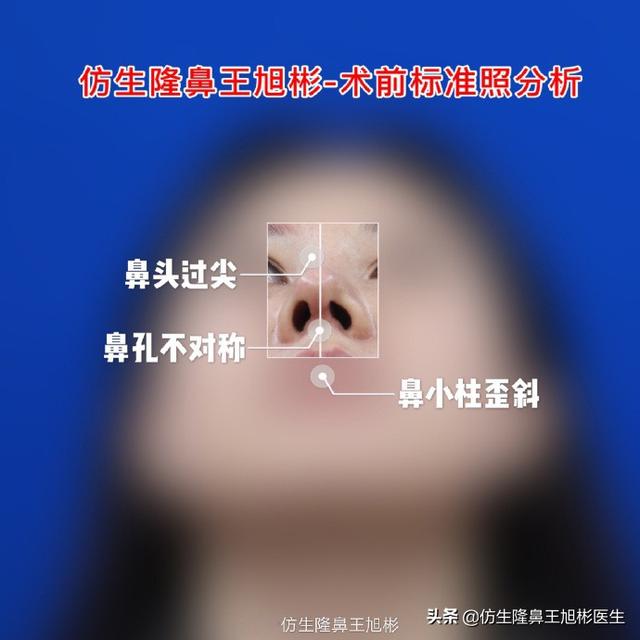 【超级宝妈】鼻尖不好看的宝宝们请看过来