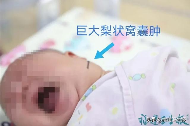 福建卫生报|莆田一出生40天女婴脖子出现巨大肿物！出现这类情况，家长一定要提高警惕