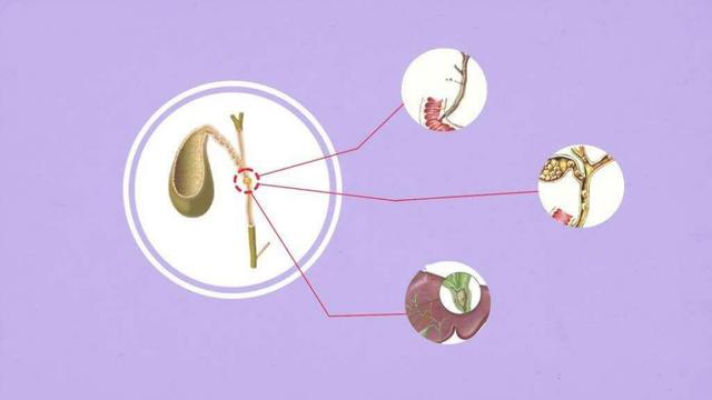 忍受腹痛折磨6年，“怕手术”的胆结石患者肝脏“很受伤”