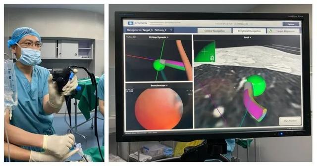 支气管镜|对付磨玻璃结节的新武器，气管里的“导航系统“来了