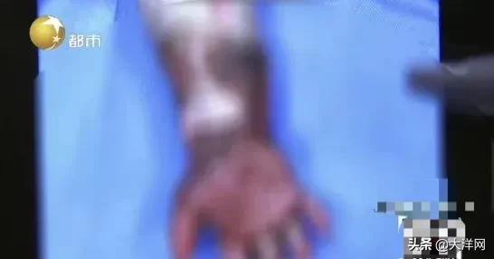 大洋网|17个月大宝宝被严重烫伤！奶奶第一时间一个举动，雪上加霜