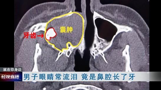 囊肿|惊呆！武汉一男子鼻腔长了牙，医生：从医40年没见过这种情况