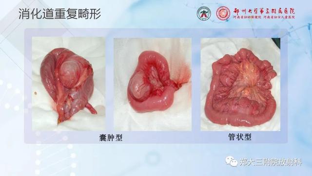 儿童腹部囊性病变诊断思路分析