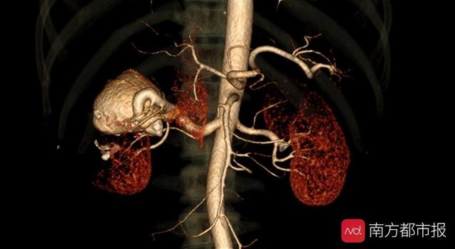 “堵”瘤保肾 巨大肾脏动脉瘤患者羊城求医成功保肾