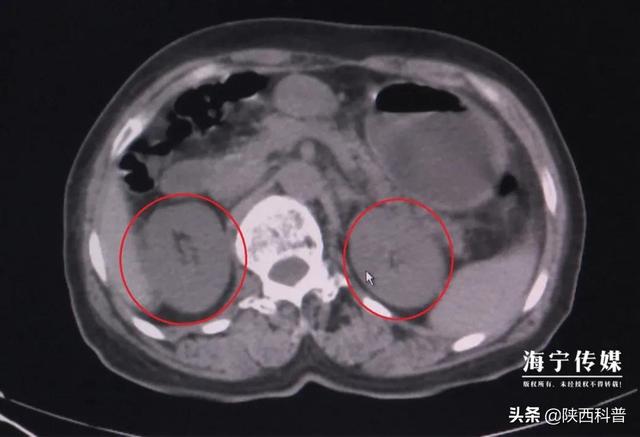 一盘家常菜让女子三天不排尿，还患上尿毒症！可能你也爱吃