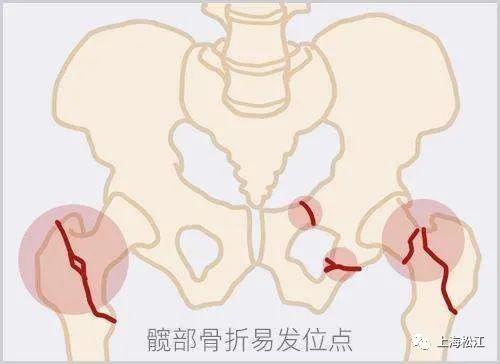 骨折|它被称为“人生最后一次骨折”，一定要提醒家人注意