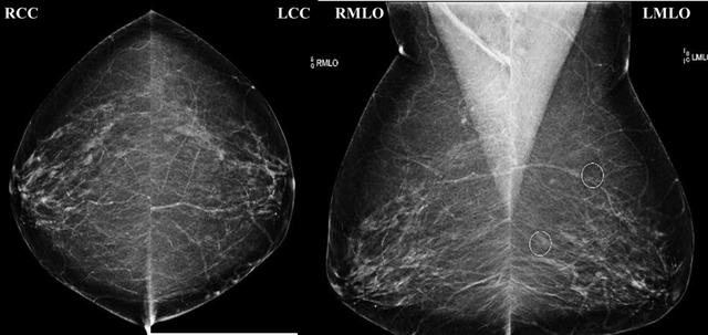 守护乳腺健康 钼靶为您护航——招远市人民医院开展钼靶检查受关注