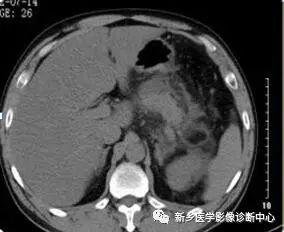 夜间值班腹部疼痛原因影像表现，值得收藏