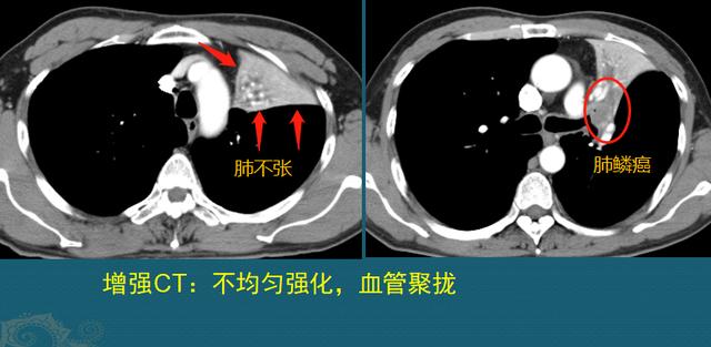 肺癌能治好吗？医生解释3个阶段的治疗数据，避免人财两空