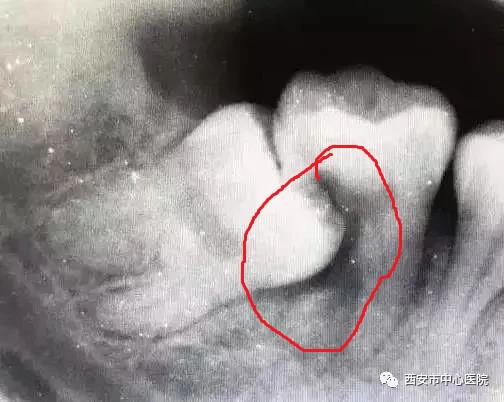 口腔科普系列——整天搞得我心神不定的智齿