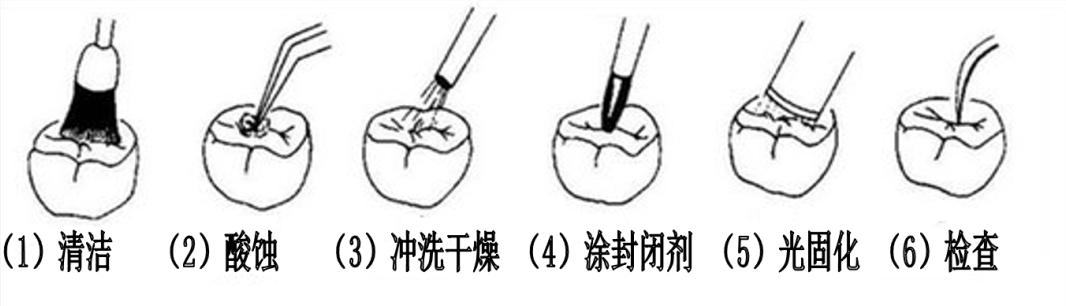 封闭|山西省汾阳医院口腔科窝沟封闭宣传走进校园