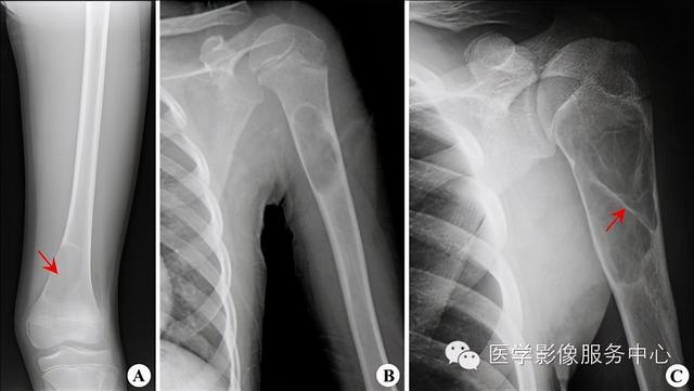 收藏 |：79种典型骨肌影像病例，助你诊断无忧