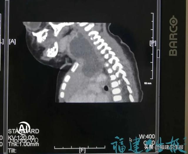福建卫生报|莆田一出生40天女婴脖子出现巨大肿物！出现这类情况，家长一定要提高警惕