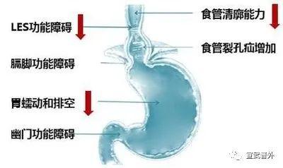 食管|经常反酸烧心是“门”没关紧