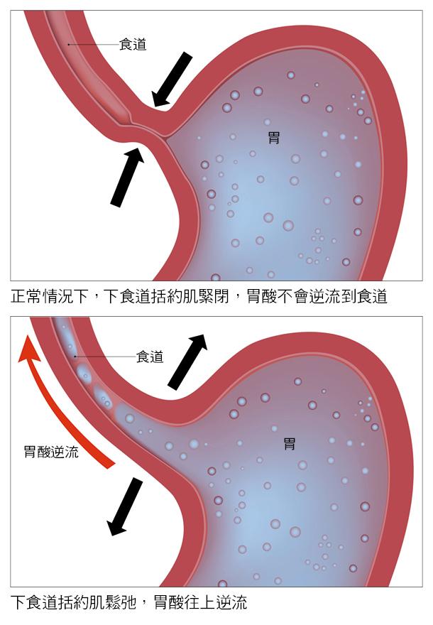 「胃」出问题，竟也会让你咳嗽、喘到不行！教你分辨气喘与感冒