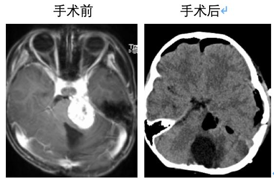 [你的育儿经]儿童脑肿瘤、儿童胶质瘤、儿童型肿瘤的一点见解