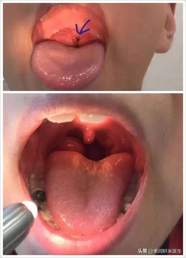 南浔的梦|米医生：腺样体手术后，为何孩子仍打呼、张嘴呼吸、严重黑眼圈？