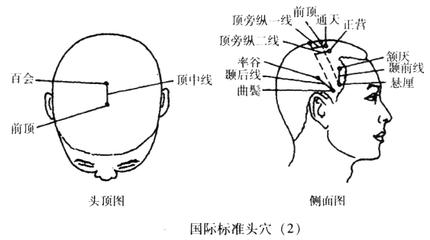 摆脱半身不遂，针灸来帮忙