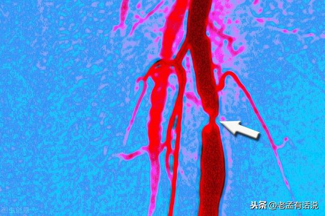 下肢发凉、麻木、乏力、疼痛不适，当心是肢体动脉粥样硬化