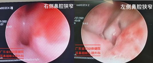 呼吸|呼吸困难七年，医生为她打通左右鼻腔