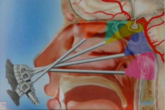 手术|运城市中心医院：鼻孔作通道 取出脑肿瘤