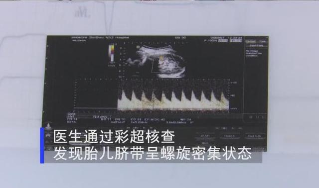 超级宝妈@胎儿调皮把脐带玩成“麻花状”，别急着夸娃聪明，背后暗藏凶险