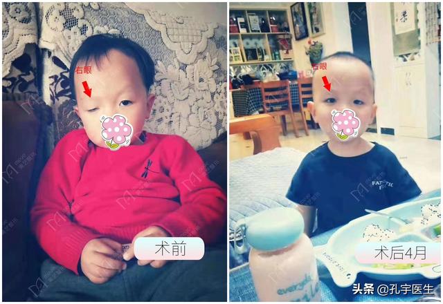 「你的育儿经」刚出生的宝宝发现一个眼大一个眼小咋回事？