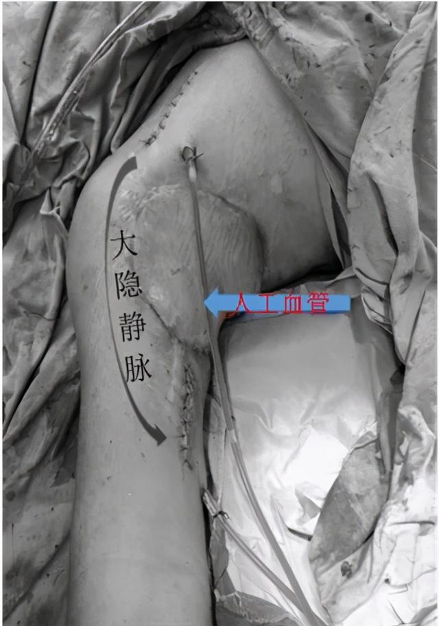 28岁小伙上肢缺血险坏死，医生以大隐静脉移植重建血管通路让他“绝处逢生”