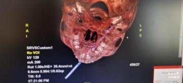 竹签|玉溪5岁男童吃搅搅糖不慎摔倒，竹签插喉7厘米…...