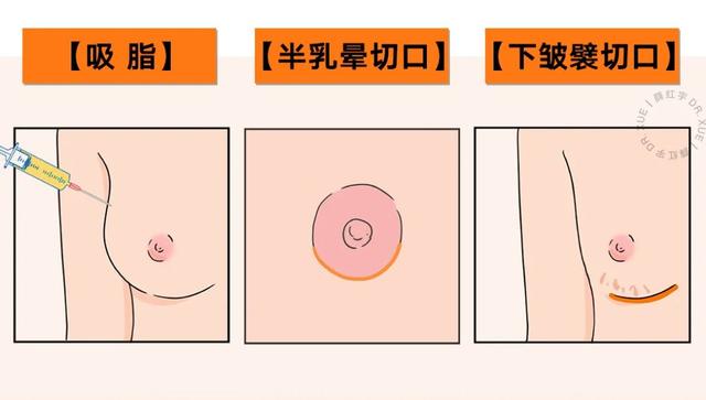 各类人群的乳房缩小术